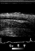  * Blood Vessel Image Reconstructed at 12500 Frames/s with Fourier Method * 