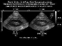  * In Vivo Experiment of a Human Kidney * 