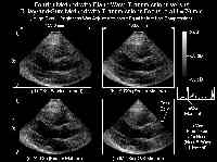  * In Vivo Experiment of a Human Heart * 